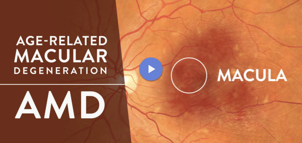 Age-Related Macular Degeneration